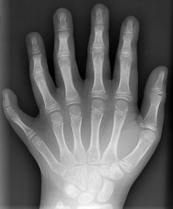 http://commons.wikimedia.org/wiki/File:Polydactyly_01_Lhand_AP.jpg