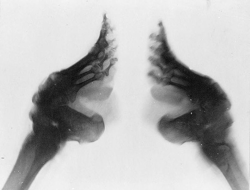 http://commons.wikimedia.org/wiki/File:Bound_feet_(X-ray).jpg