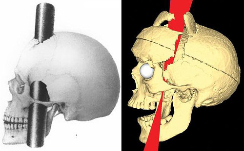 https://commons.wikimedia.org/wiki/File:PhineasGage_IronPaths_BigelowRatiuCombined.jpg