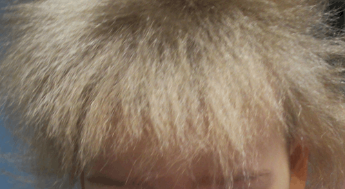 https://commons.wikimedia.org/wiki/File:Scalp_hair-uncombable_hair_syndrome.gif